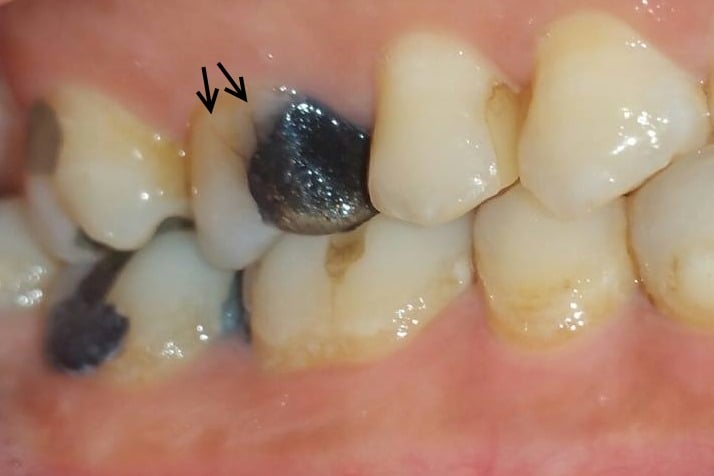 Cracked tooth syndrome - dental diagnosis