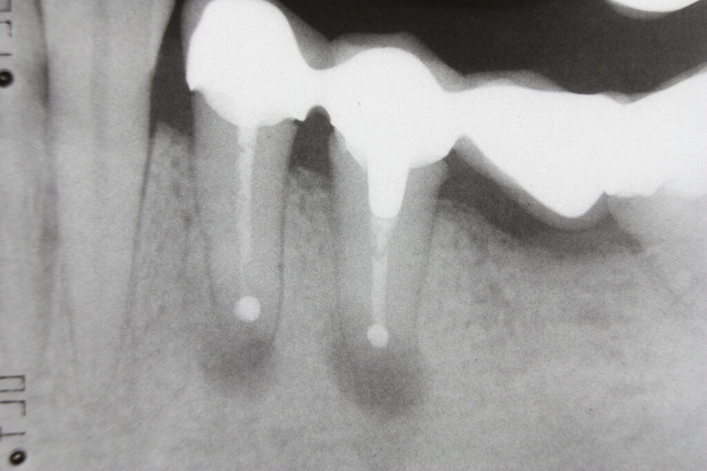 Dental X-ray after endodontic microsurgery apicoectomy procedure