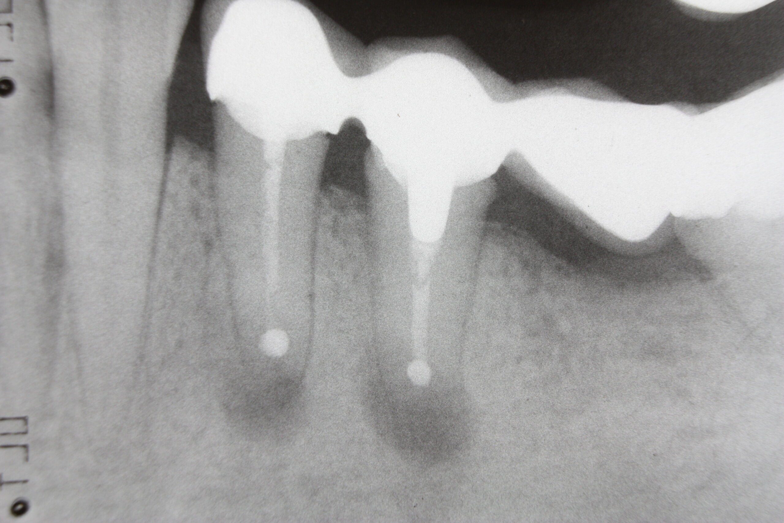 Dental X-ray after endodontic microsurgery apicoectomy procedure
