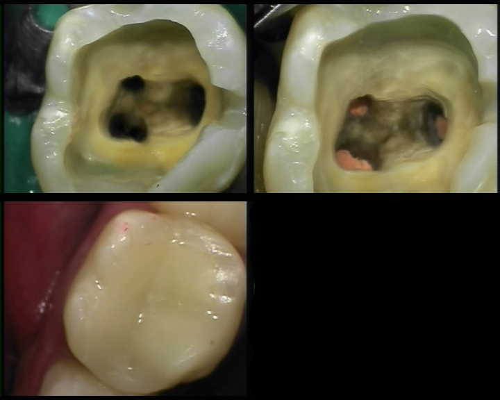 Clinical images of root canal revision retreatment procedure