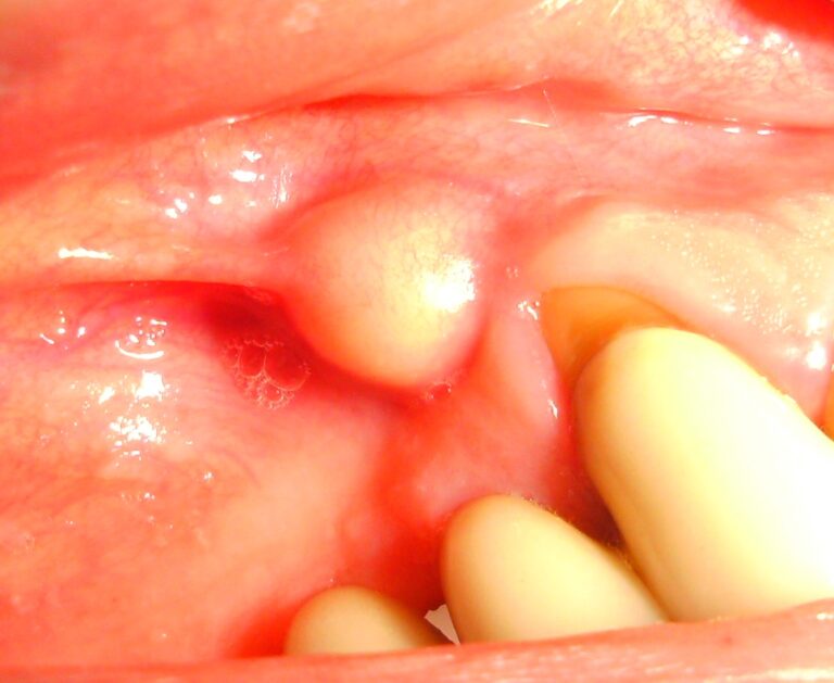 Periapical abscess X-ray showing signs of infection requiring root canal treatment