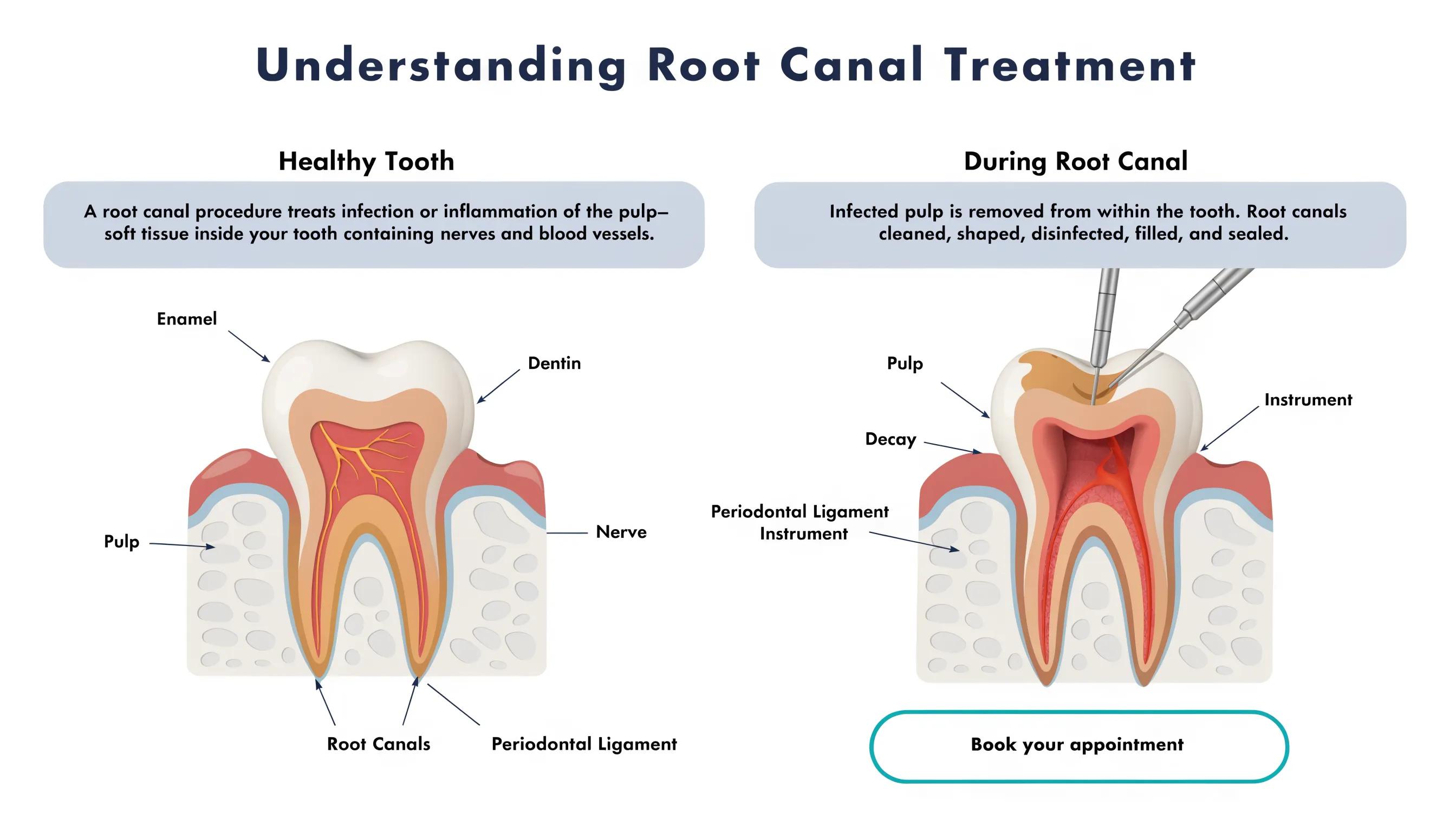 Illustration of root canal procedure with labeled parts of a tooth and clear visual representation